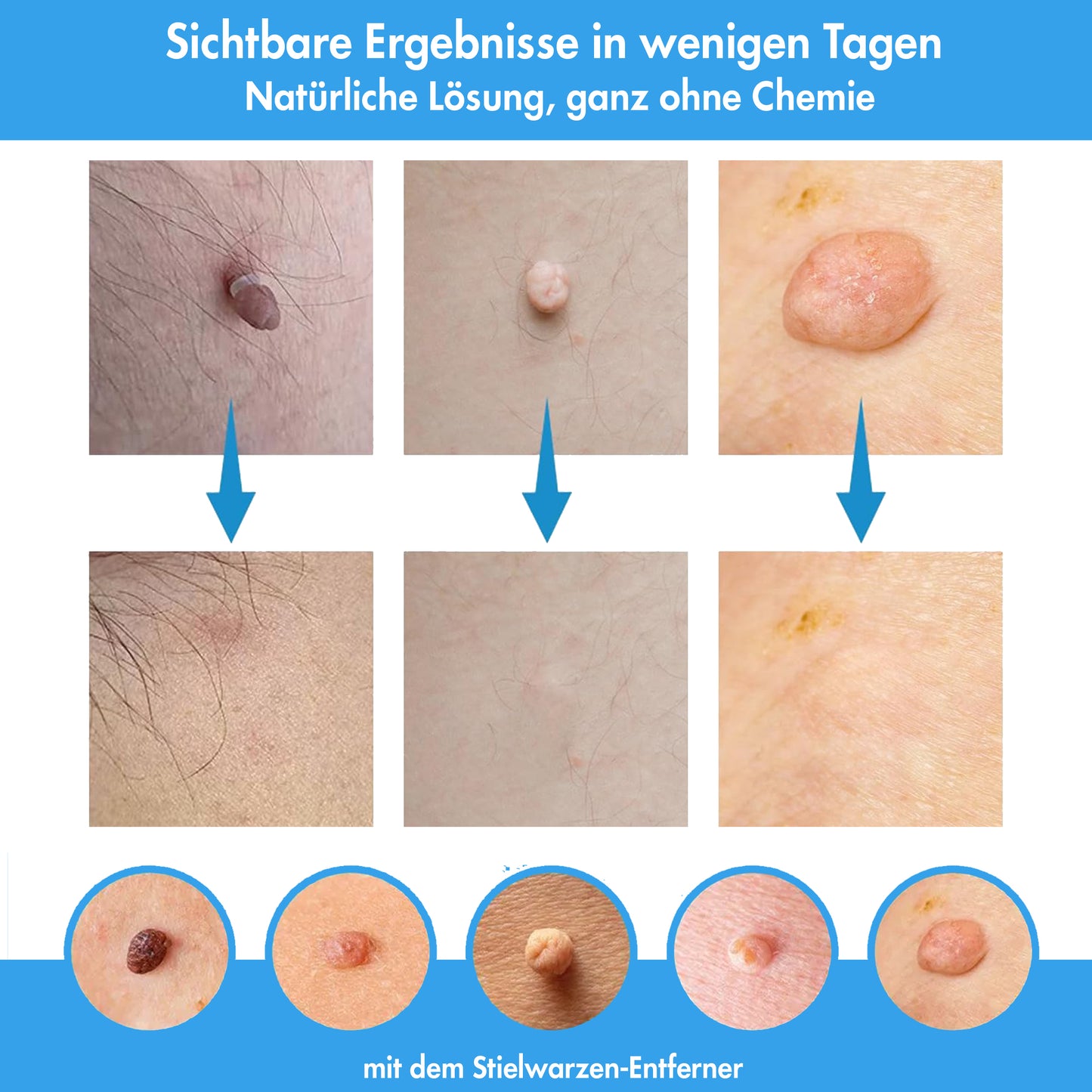 Stielwarzen Entferner Set -  einfache Anwendung zu Hause