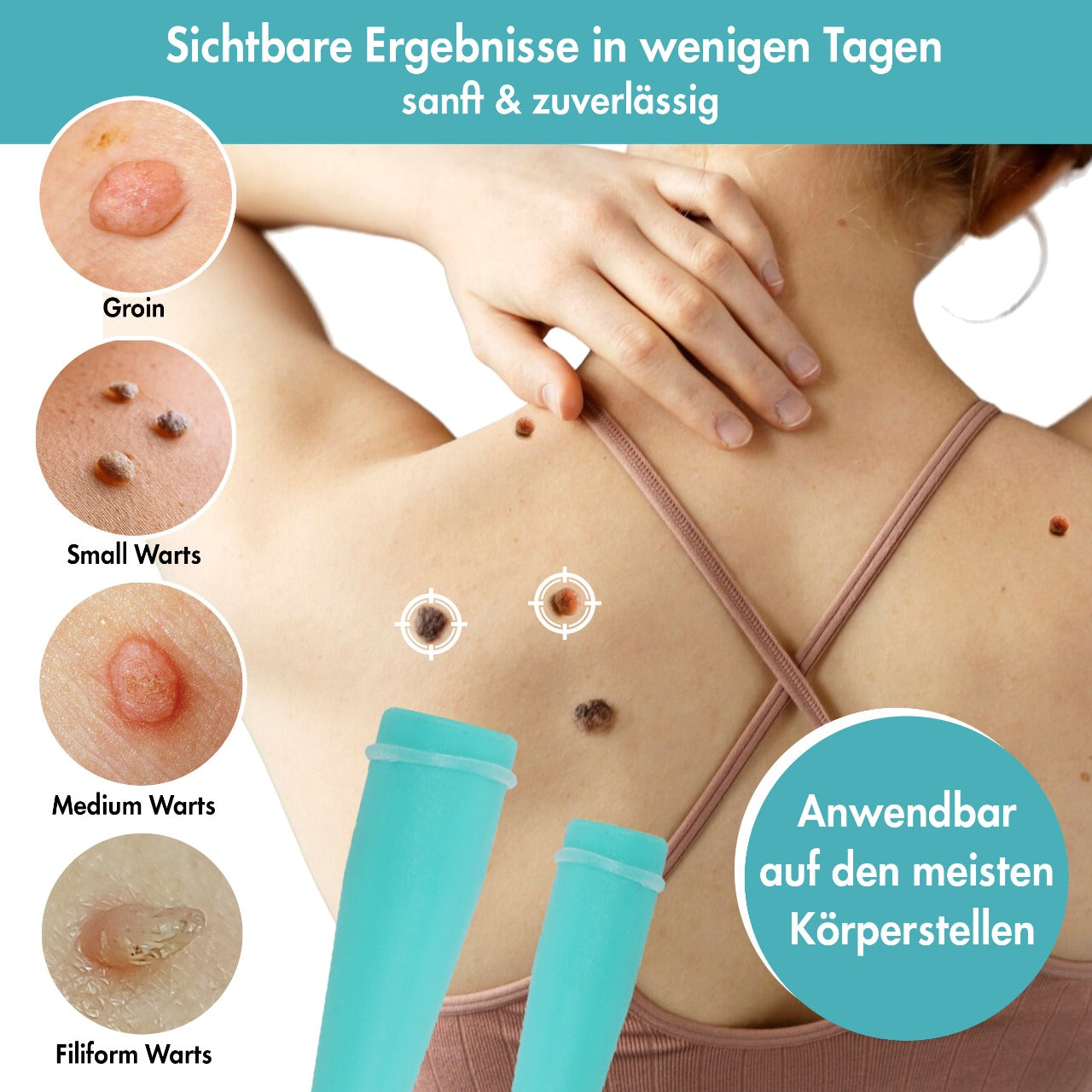 Stielwarzen Entferner โ Stielwarzen selbst entfernen -  Wirksam, Sicher & Einfach ohne Chemie