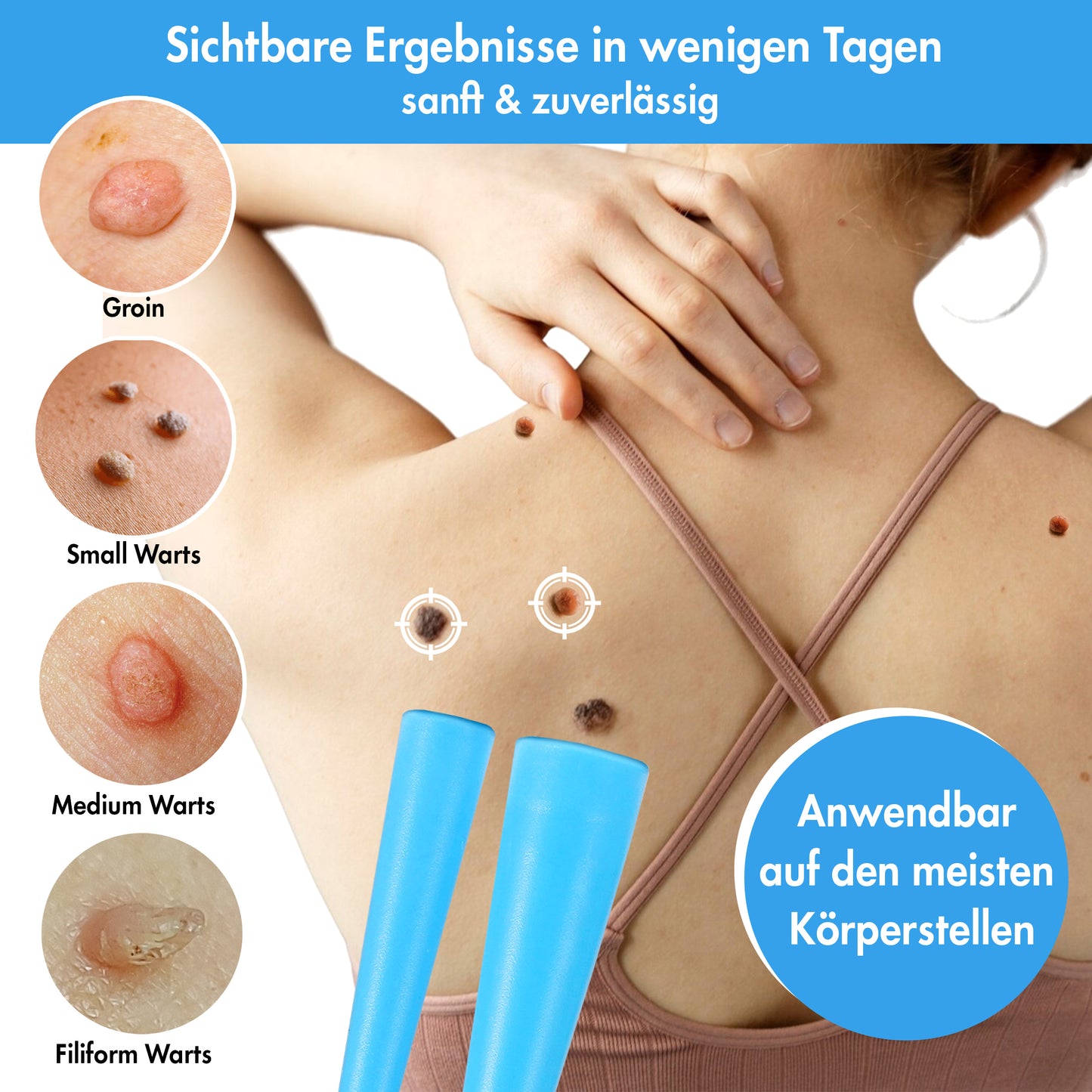 Stielwarzen Entferner Set -  einfache Anwendung zu Hause