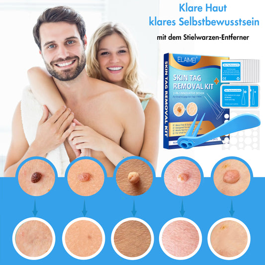 Stielwarzen Entferner Set -  einfache Anwendung zu Hause