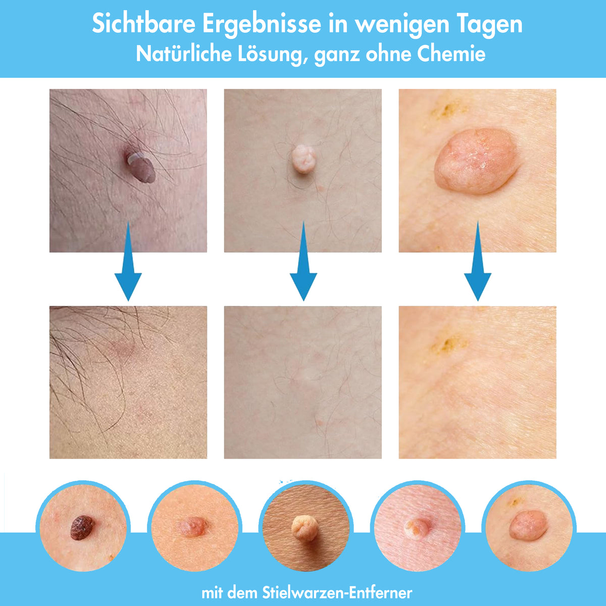 Stielwarzen Entferner Set (für große Warzen)