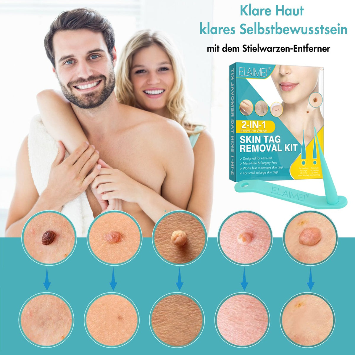 Stielwarzen Entferner