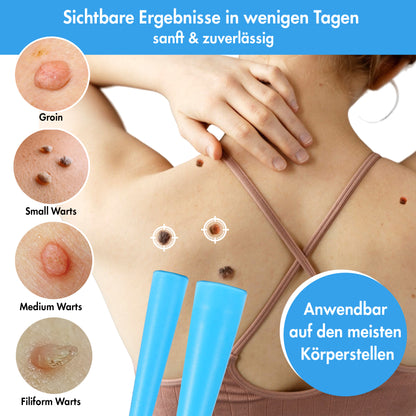 Stielwarzen Entferner Set -  einfache Anwendung zu Hause