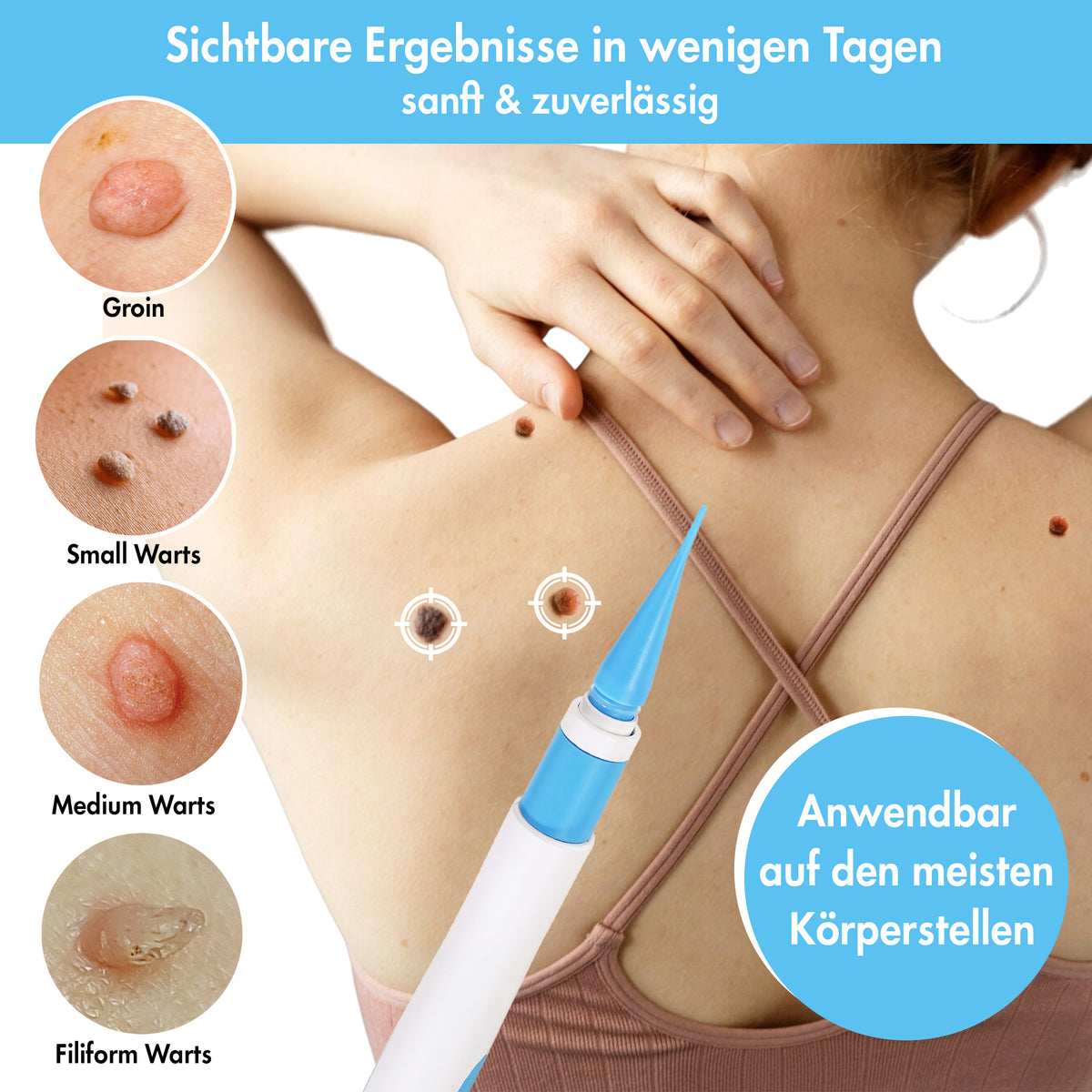 Stielwarzen Entferner Set (für große Warzen)