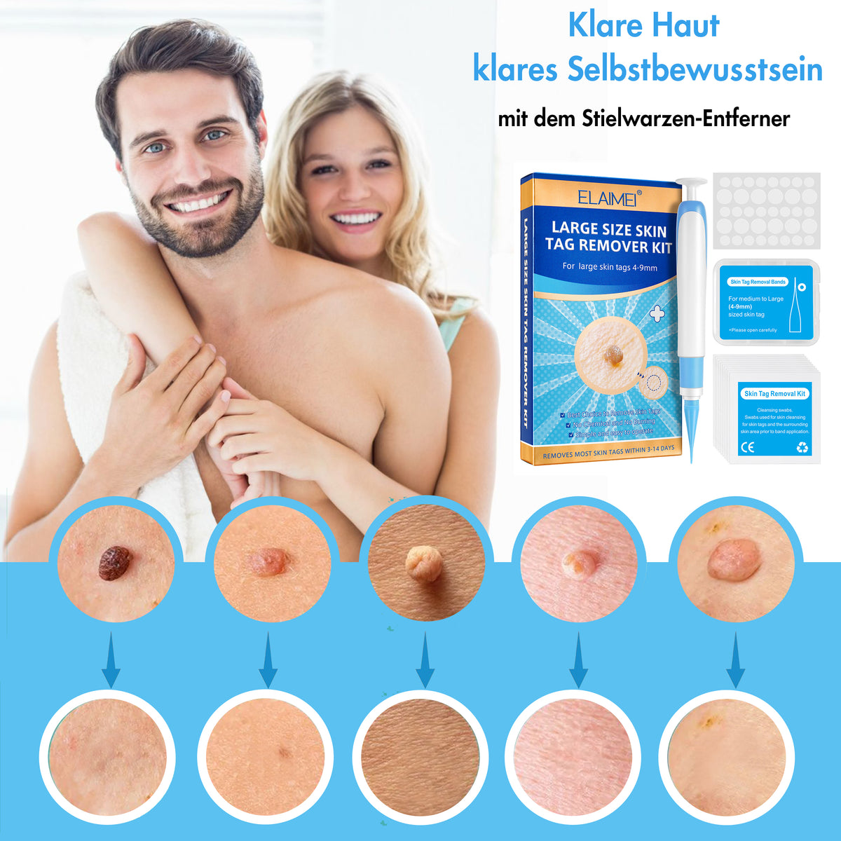 Stielwarzen Entferner Set (für große Warzen)